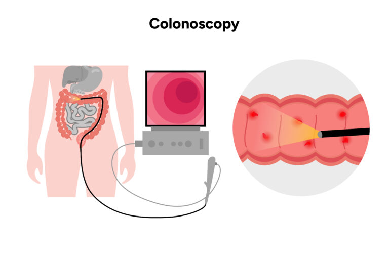 Colonoscopy