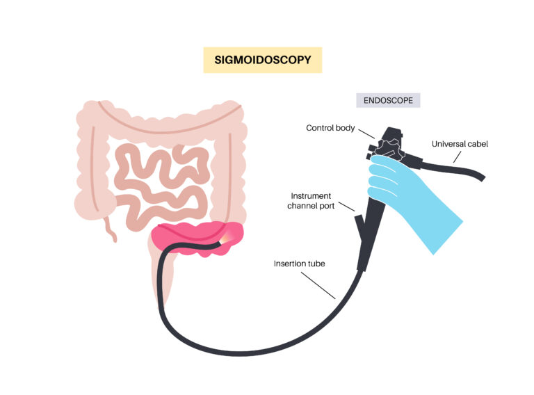 sigmoidoscopy