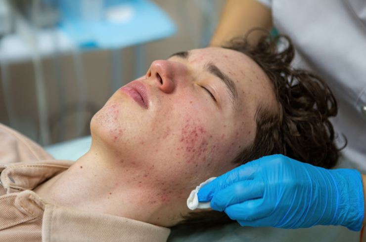 Acne Scar Treatment